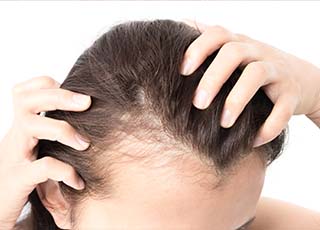 Hair fall Treatment